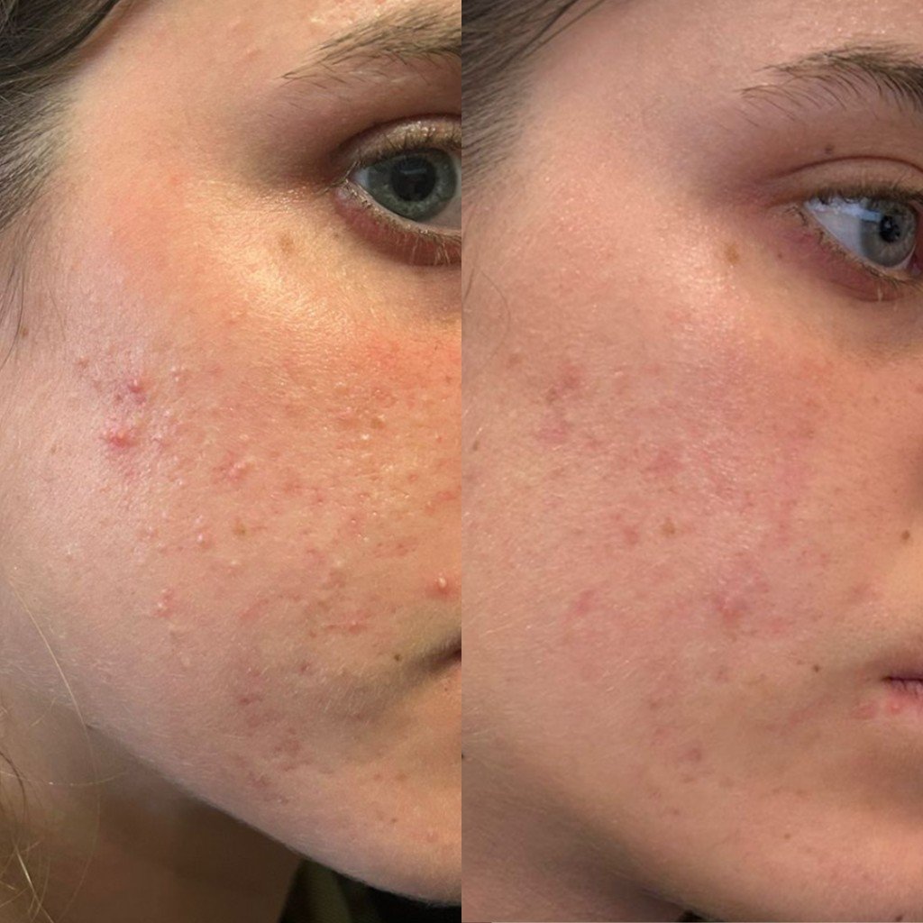 השוואת לפני ואחרי טיפול