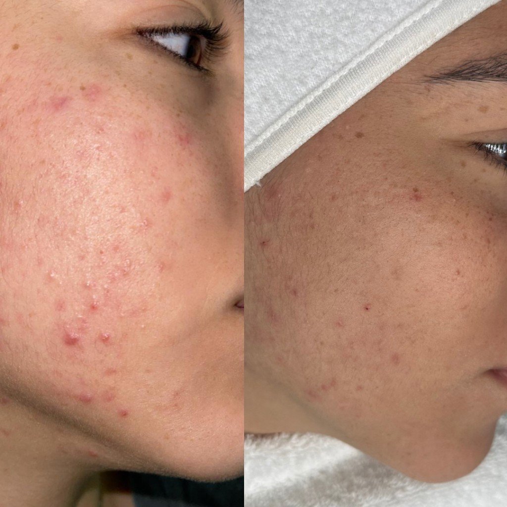 השוואת לפני ואחרי טיפול